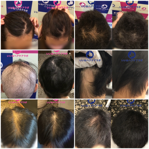 薬なし薄毛専門いいね鍼灸院のこだわりポイント