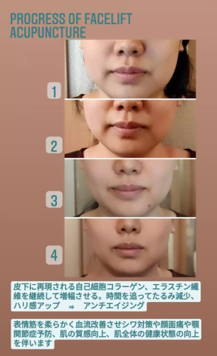 im.Hari™イムハリ全身美容鍼 Body+Beauty Facial Acupuncture 府中のこだわりポイント