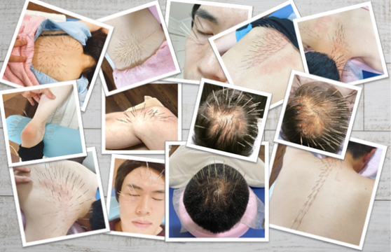 青葦 あおい 鍼灸治療院 一宮 稲沢 愛西の鍼灸院