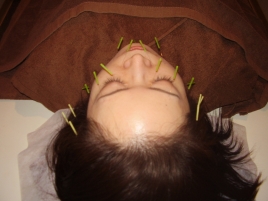 イグザス鍼灸マッサージ治療院 美容鍼灸コースのメニュー画像