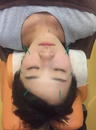 瑞江ＴＢＭ鍼灸整骨院 美容鍼のメニュー画像