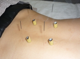 はる鍼灸治療院 通常治療（全身治療）のメニュー画像