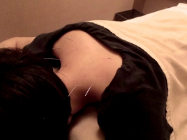 和苑 鍼灸（はり灸）コースのメニュー画像