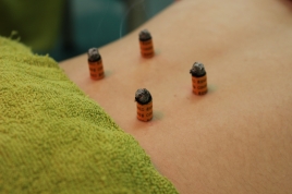 メトロはりきゅう整骨院 はり・灸治療（保険）のメニュー画像