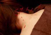 美容鍼灸サロン Pierce ボディケアプランのメニュー画像