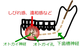 歯やお顔の痛み・しびれのお悩みに　YNSAの紗楽鍼灸院 口腔顔面疾患のはり施術のメニュー画像