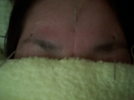 はりきゅう／整体の一鍼治療院　 美顔鍼のメニュー画像