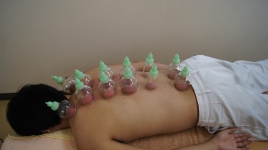沖縄県那覇市首里スマイル鍼灸整骨院　本院 吸い玉（ぶーぶー）治療のメニュー画像