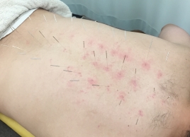 すずらん鍼灸接骨院黒川Ｅａｓｔ院 鍼灸治療のメニュー画像