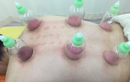 すずらん鍼灸接骨院黒川Ｅａｓｔ院 吸い玉のメニュー画像