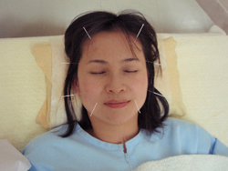 中国鍼灸　健身院 鍼灸美顔コースのメニュー画像