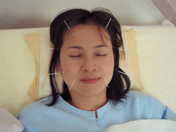 中国鍼灸・健身院 鍼灸美顔コースのメニュー画像