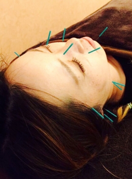 はり・きゅうサロンみかづき 美容鍼灸＋カッサ(初回)のメニュー画像