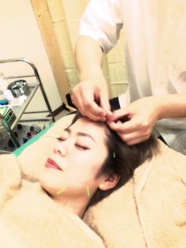 北の谷の鍼灸院 (Seaside Acupuncture Center) 美容鍼のメニュー画像
