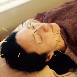 まっさ鍼灸整骨院　西八王子院 美容鍼のメニュー画像