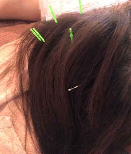 shishira (シシラ）はり灸治療院 頭皮鍼のメニュー画像