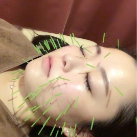 夏奈鍼灸接骨院 初回4400円☆高濃度酸素美容鍼のメニュー画像