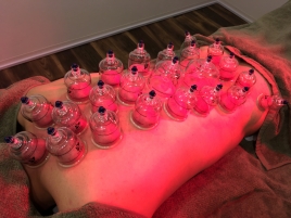 鍼灸整骨院　善光 吸角（カッピング）のメニュー画像