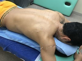 HAPPY(ハッピー)鍼灸院 北京堂 浅野式の鍼治療　１コマのメニュー画像