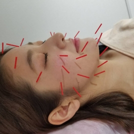 A&S鍼灸治療院 美容鍼 プラチナコース(約50本)のメニュー画像