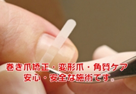 つつみ鍼灸整骨院 巻き爪矯正のメニュー画像