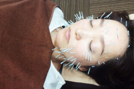 まちだ駅前鍼灸院整骨院 健康美容鍼灸コースのメニュー画像