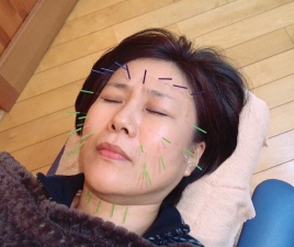 藤井治療院 美容鍼　スタンダードのメニュー画像