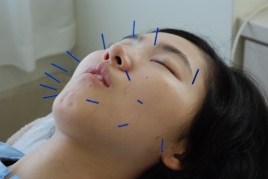 本郷まこと治療院 身体から美しくする美容鍼ベーシックコースのメニュー画像