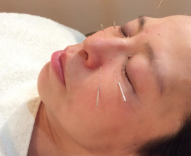 まちだ駅前鍼灸院整骨院 花粉症・慢性鼻炎鍼治療のメニュー画像