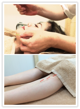 北の谷の鍼灸院 (Seaside Acupuncture Center) トータル美容鍼灸のメニュー画像