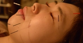 鍼呼灸 森の音 美容鍼60分(鍼灸＋首肩顔マッサージ)のメニュー画像