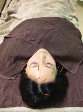 一会堂鍼灸整骨院 美容鍼フェイシャルのメニュー画像