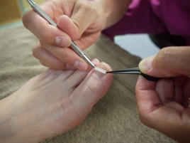 美容鍼灸整体 Olive de mignon 巻き爪ケアのメニュー画像
