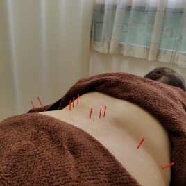 くまちゃん鍼灸院 鍼のメニュー画像