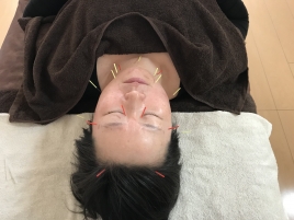 美容鍼灸サロンLupinus ハリウッド上田式美容鍼灸ベーシックのメニュー画像