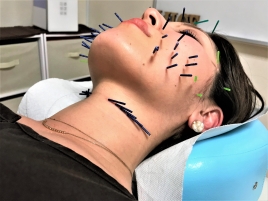 ルーチェ鍼灸整骨院 美容鍼【オーダーメイドコース】（顔）のメニュー画像