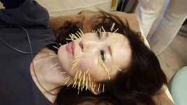 バリアフリー鍼灸整骨院 美容鍼コースのメニュー画像