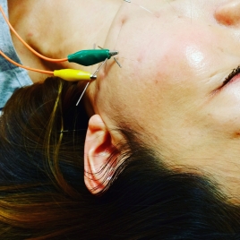 美容鍼灸治療院Tiffy パルス美容鍼ゴールドのメニュー画像