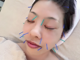 漢方鍼灸院　ナチュラルオリエント目白 美容鍼ショートのメニュー画像
