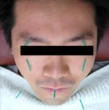 りゅうえい治療院 鍼灸治療のメニュー画像