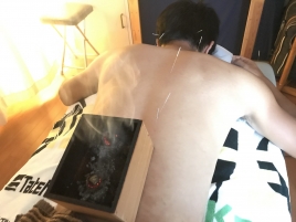 福鍼灸 TF Conditioning 鍼灸治療のメニュー画像