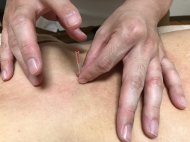 つちやま鍼灸院 松山市山越本院 鍼灸治療のメニュー画像