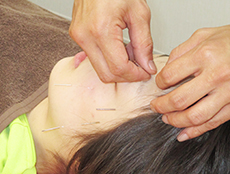 朝陽鍼灸接骨院 鍼灸治療　美容鍼のメニュー画像