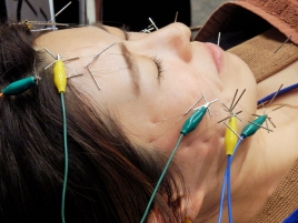 陽なた鍼灸・整骨院 電気を流す美顔鍼のメニュー画像