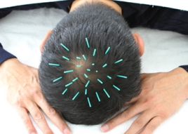 本山さくら鍼灸サロン 初回限定　育毛・薄毛・円脱　鍼灸のメニュー画像