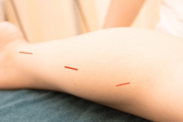 ハイライト・ボディケア 鍼灸マッサージ治療院 鍼灸治療のメニュー画像