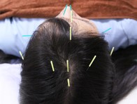 紗亜奈鍼灸治療院 ストレス緩和メニュー　頭鍼のメニュー画像