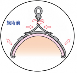 なごみ鍼灸整骨院-京都亀岡- 巻き爪ワイヤー矯正コースのメニュー画像