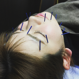 じん鍼灸整骨院　平松本町院 美容針・美容鍼のメニュー画像