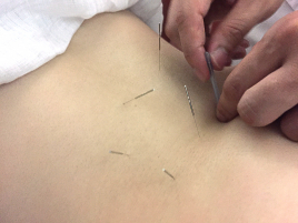 じん鍼灸整骨院　平松本町院 鍼灸（鼻炎・自律神経・腰痛など）のメニュー画像